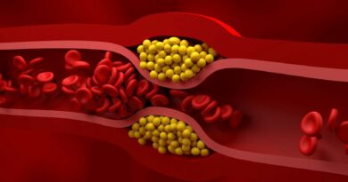 Širdies ligos – negailestingiausias žudikas visame pasaulyje neišskiriant ir Lietuvos. Tačiau didelis cholesterolis jas sukelia toli gražu ne visada, atskleidė naujausias tyrimas.