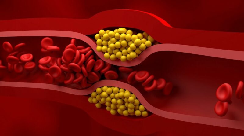 Širdies ligos – negailestingiausias žudikas visame pasaulyje neišskiriant ir Lietuvos. Tačiau didelis cholesterolis jas sukelia toli gražu ne visada, atskleidė naujausias tyrimas.